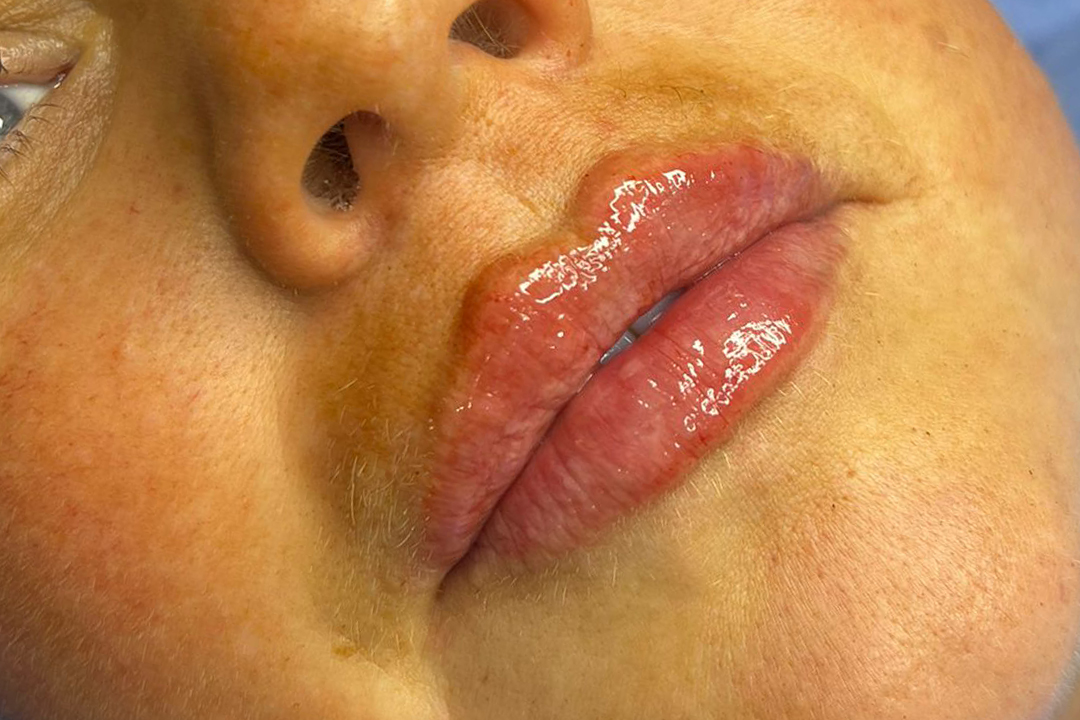 After-Lip Filler